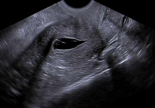 normal uterus on sonohysterogram
